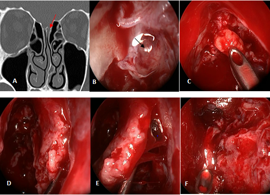 Figure 4: Ethmoid Meningocele A: Computed Tomography (Arrow Indicates the Meningocele); B: Meningocele (Arrow); C: Intradural Fat Placement After Reducing the Meningocele with Bipolar Cautery; D: Resection of the Medial Half and Bone of the Middle Turbinate; E: Medial Rotation of the Lateral Mucoperiosteum of the Middle Turbinate; E: Defect Repair.