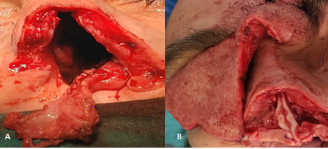Figure 7: Total Rhinectomy A: Lateral Wall Flap with Anterior Pedicle for Reconstructing Nasal Mucosal Lining; B: Support was Reconstructed with Auricular Concha Grafts, and Skin Coverage with a Frontal Midline Flap.