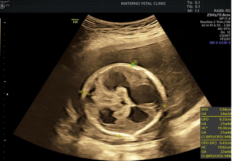 Figure 5: Two-dimensional ultrasound showing ventriculomegaly of the studied patients.