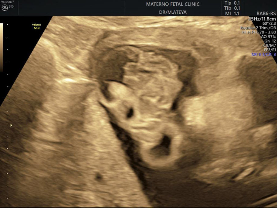 Figure 8: Two-dimensional ultrasound showing exencephaly of the studied patients.
