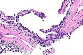 Figure 2: Atypical adenomatous hyperplasia delineating alveolar spaces lined by columnar epithelial cells permeated with eosinophilic cytoplasm, enlarged, hyperchromatic nuclei with enhanced nucleocytoplasmic ratio and mild cellular and nuclear atypia. Circumscribing pulmonary parenchyma appears mildly inflamed and fibrotic [7].