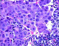 Figure 2: SMARCB1 deficient medullary renal cell carcinoma enunciating sheets and solid areas of pleomorphic cells incorporated with eosinophilic cytoplasm, enlarged hyperchromatic nuclei with vesicular chromatin and prominent nucleoli. Surrounding stroma is infiltrated by lymphocytes [6].