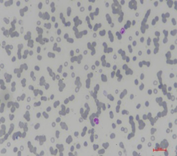 Figure 1: Types of Serum monoclonal protein in patients with Multiple myeloma (n=61).