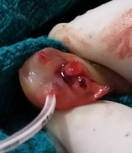 Figure 1: Cut section of the umbilical cord showing 3 arteries and UVC inserted into the vein.