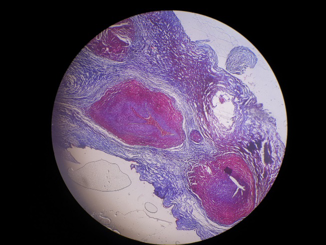 Figure 2: Histopathological examination showing 3 arteries and 1 vein.