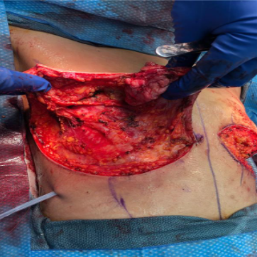 Figure 1: An intraoperative picture of the superomedial pedicle and lateral breast flap, both of which were thinned to 2-cm thickness to allow for a masculine appearance while preserving the lateral branch of the anterior cutaneous branch of the intercostal nerve innervating the nipple-areolar complex.
