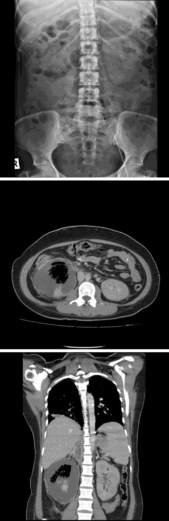 Figure 1: AXR showing enlarged right kidney with gas in parenchyma.