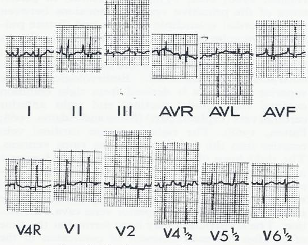 Figure 10: Posteroanterior view of the chest x-ray showing moderate cardiomegaly and increased pulmonary vasculature. Reproduced from Rao PS, Silbert DR. Brit Heart J 1974; 36:228-32.