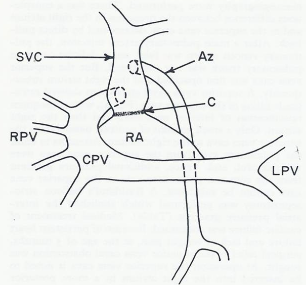 Figure 13: Diagrammatic sketch of the pulmonary venous return found on postmortem examination. Two pulmonary veins drain the left lung fuse and form a common pulmonary vein (CPV) which traverses to the right and then ascends to empty into the postero-lateral aspect of the superior vena cava (SVC). Four right pulmonary veins (RPVs) join the lateral convexity of the CPV. The position of the azygos vein (Az) opening into the SVC and the constricted site of the SVC (arrow) are also shown. C, constricted area of the SVC; LPV, left pulmonary veins; RA, right atrium. Reproduced from Rao PS, Silbert DR. Brit Heart J 1974; 36:228-32.