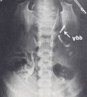 Figure 3: Abdominal x-ray film following intravenous pyelogram and barium swallow demonstrating appendix (App) on the left side. Also note that the liver shadow on the right and stomach bubble on the left, leading to the conclusion of partial visceral heterotaxia. Reproduced from Rao PS, Molthan ME, Am J Dis Child 1973; 125:749-52.