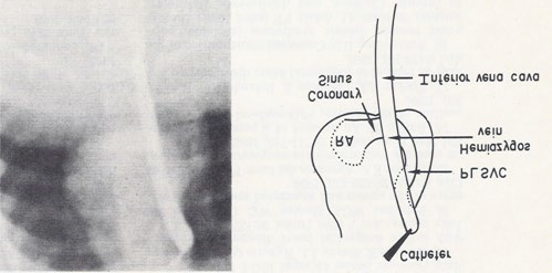 Figure 5: Selected frame from inferior vena caval cine-angiogram in postero-anterior projection, demonstrating the connection of the inferior vena cava to the hemiazygos vein which empties into to a persistent left superior vena cava (PLSVC), which in turn empties into the coronary sinus and right atrium (RA). The line drawing on the right are provided to improve the clarity. Reproduced from Rao PS, Molthan ME, Am J Dis Child 1973; 125:749-52.