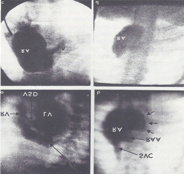 Figure 7: Selected left ventricular (LV) cine-angiographic frame in left anterior oblique view demonstrating a ventricular septal defect (VSD). The right ventricle (RV) is opacified via the VSD and looks close to normal in size. b. Selected right atrial (RA) cine-angiographic frame in postero-anterior view prior to opacification of the left atrium (LA). The contrast material delineates the atretic tricuspid valve and is shown by small unlabeled arrows. This is rounded and extends more to the left than in other tricuspid atresia cases. c and d. Right atrial angiographic frames from two patients with classic tricuspid atresia are shown for comparison with figure b. These frames are frozen prior to full opacification of the LA. PA, pulmonary artery; RAA, right atrial appendage; SVC, superior vena cava. Reproduced from Rao PS, et al. [7].