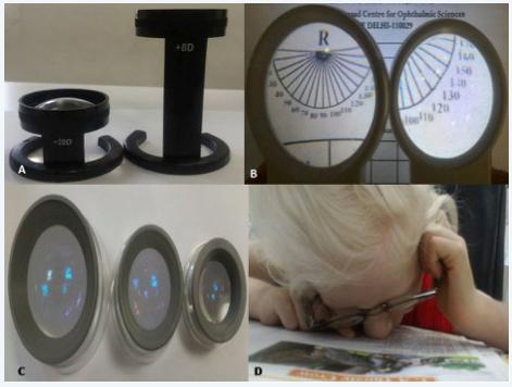 Figure 1: Disadvantages of higher magnification: (A) Different focus for different powers (stand magnifiers of +8 and +20 D); (B&C) Progressively smaller field of view with increasing diopetric strength of magnifiers; (D) Close reading with spectacle magnifiers.