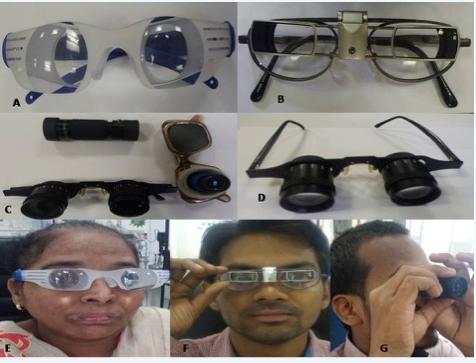 Figure 4: Optical low vision devices for distance: (A) See TV magnifier for a distance of 3 meters; (B) Ocutech Bioptics; (C, D) Telescopes – uniocular hand-held and spectacle-mounted; (E) Binoculars: Spectacle Mounted Telescope; (F) Patient reading with SEE TV Glasses; (G) Use of Sight Scope Bioptix for Distance; (H) Use of Uniocular Hand Held Telescope. Magnifying Spectacles (High Plus Reading Glasses) Normally, near addition in glasses can be prescribed upto+3.5Dsphere (S). Add greater than this is called a high plus add. Higher the addition, closer is the reading distance. The various forms of low vision spectacles are: • For binocular correction prism spectacles (half or full field) are used. The commonly available powers are +4D, +5D, +8D, +10D, +12.0D, +16D, +20D, +24D. Base in prisms are added to compensate for the convergence angle of the eye and facilitate binocularity (1Δof base- in prism is incorporated for each diopter of reading addition). • For monocular correction high plus aspheric spectacles are used, with commonly available powers being +4.0D to +10.0D, +12.0D, +14.0D, +16.0D, +20.0D, and +24.0D. The design should preferably be aspheric to prevent peripheral distortions and enhance the field of vision. The better eye is corrected, and the other eye is prescribed a balance or a plano lens. • Spectacle magnifiers are also available with Fresnel prisms for low powers only. A study comparing the performance of prism spectacles versus conventional spectacles, reported that prism spectacles were not beneficial in visual impairment due to age-related macular degeneration [17]. The optical quality of the lens used for magnifying spectacles should be as follows: 1. Aspheric design – eliminates peripheral aberration and provide reasonable field 2. Plastic lenses – high index lenses, therefore reduces the thickness and weight as compared to glass 3. Feinblooms doublet design eliminate spherical and chromatic aberrations and provide wider field than aspheric lenses 4. Antireflection coatings help eliminate unwanted reflections from lenses and increase light transmission Prescription of magnifying spectacles • Addition is given over the distance correction • Reading distance =