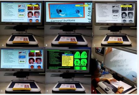 Figure 6: Desktop magnifiers: (A) Normal contrast; (B) Zoom settings: Zoom 8; (C) Black and white contrast; (D) Contrast and brightness settings; (E) Green over black and contrast settings; (F) Desktop Magnifier – writing is easy. Closed Circuit Television (CCTV) CCTV consists of a monitor, a camera, a table or a platform where the reading material can be placed. It has controls for brightness, contrast, colour and magnification. Magnification can be varied from 3x to 70x. Current video magnification systems include: • Desktop CCTV with enhanced features (autofocus, speech commands, flat screens, text manipulations). • Handheld cameras/portable devices. • Head mounted systems where camera and LCD displays are combined in a single unit. **Advantages** • Higher magnification up to 70x. • Binocularity. • Patient can sit at comfortable reading distance. • Hands are free for writing, etc. **Disadvantages** • Expensive. • Need more training and practice. A study reported better reading performance with optical than with head-mounted electronic devices. However in two other studies, electronic stand-based (camera and monitor) CCTV and a hand-held CCTV (14- inch monitor at 40 cm) allowed faster reading than optical devices. This difference in results could be explained by the evolving and improving technology for electronic devices [17].