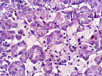 Figure 1: Eosinophilic solid and cystic renal cell carcinoma demonstrating cysts layered with epithelial cells imbued with abundant, Eosinophilic cytoplasm, intracytoplasmic vacuoles and uniform nuclei with prominent nucleoli. Few foamy macrophages are discerned [6].
