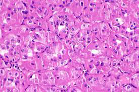Figure 2: Eosinophilic solid and cystic renal cell carcinoma delineating cysts lined by cells pervaded with abundant, Eosinophilic cytoplasm, intracytoplasmic vacuoles and mildly pleomorphic nuclei with conspicuous nucleoli [7].