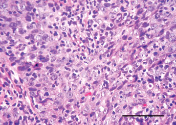 Figure 1: Lymphoepithelial carcinoma delineating syncitia of enlarged, polygonal cells imbued with abundant, eosinophilic cytoplasm and vesicular nuclei with prominent nucleoli. Tumour cells are enmeshed by small lymphocytes and plasma cells [5].