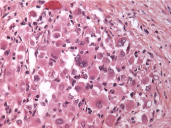 Figure 2: ALK rearranged renal cell carcinoma exhibiting clusters of cells pervaded with eosinophilic cytoplasm, intracytoplasmic mucin, vesicular nuclei and inconspicuous nucleoli. Tumour cells infiltrate the renal parenchyma [6].