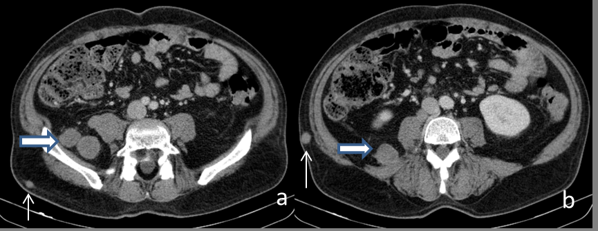 Figure 2: Abdominal CT scan, portal venous phase -a, b - solid nodules in the subcutaneous fat (arrow) and retroperitoneal fat (blue arrow).