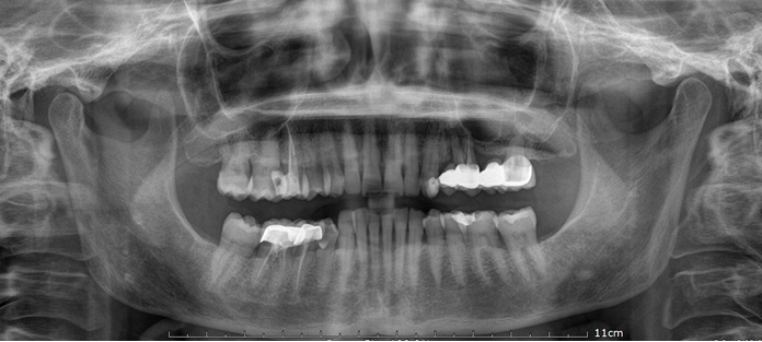 Figure 1: Orthopantomagram x-ray before treatment.