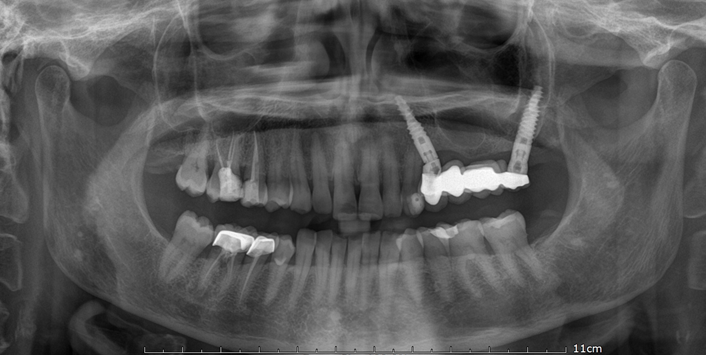 Figure 3: Orthopantomagram x-ray 6 months after treatment. Definitve 4 unit fixed implant-supported zirconia prosthesis.