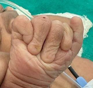 Figure 2: Absent nails in Right hand.