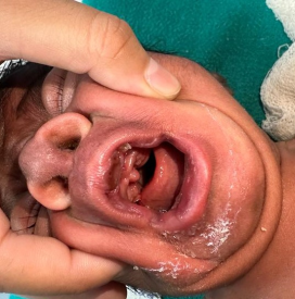 Figure 3: Gum Hypertrophy.