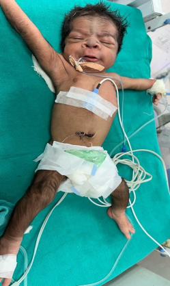 Figure 5: Hypertrichosis in B/L upper & lower limbs.