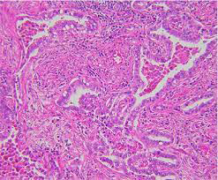 Figure 1: Minimally invasive adenocarcinoma delineating predominant lepidic pattern with neoplastic cells layering alveolar spaces. Foci of invasion within subjacent stroma are encountered [7].