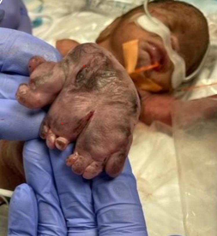 Figure 2: Postnatal physical exam of neonate with Sirenomelia showing fused feet with 11 total toes.