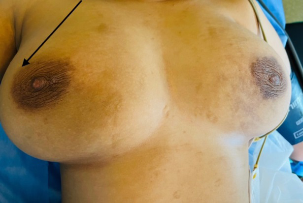 Figure 1: Photographic image of our patient asymmetrical breasts. Black arrow showing upper outer quadrant’s curvature of the right breast.
