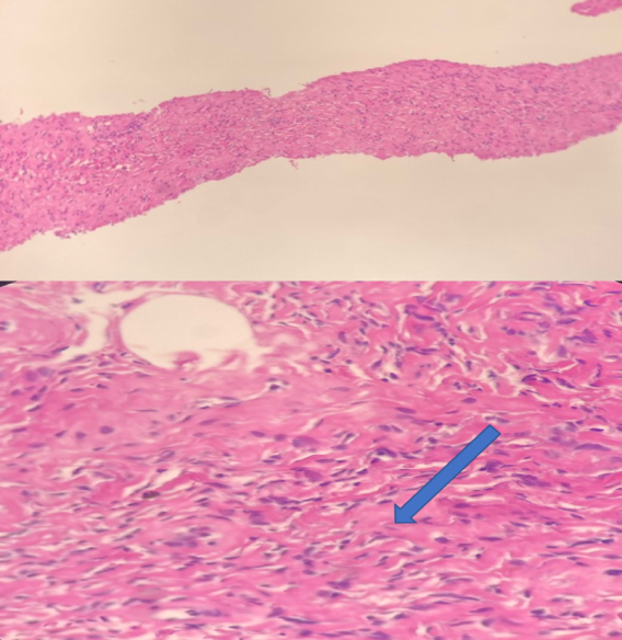 Figure 4: Histological appearance of proliferation fuse tumor cell architecture fascicles with spindle-shaped bundle with blue arrow showing the unusual oval nucleus without necrosis or sign of malignancy.