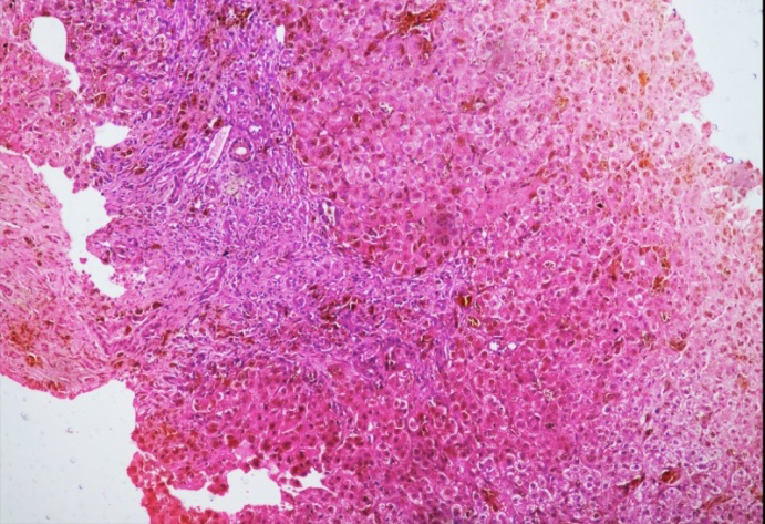 Figure 1: Low power showing portal inflammation, interface hepatitis and brown pigment.