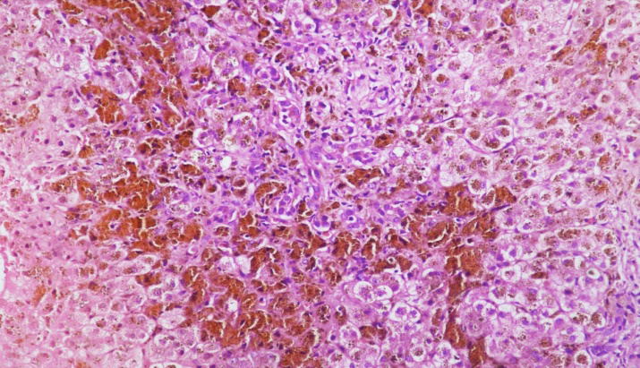 Figure 2: High power showing balloon degeneration, abundant hemosiderin pigment, rosette formation, ductular proliferation.
