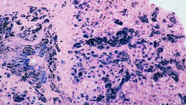 Figure 3: Perls stain highlight intrahepatic, sinusoidal, Kupffer cell, biliary epithelial cell and portal macrophage hemosiderin deposition.