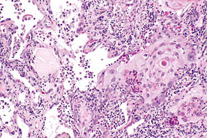 Figure 1: Squamous cell carcinoma demonstrating keratinized polygonal tumour cells imbued with abundant, eosinophilic cytoplasm, enlarged vesicular nuclei with prominent nucleoli and enhanced nucleocytoplasmic ratio. Surrounding stroma is inflamed.