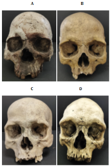 Figure 1: Sample size of the present study was as follows: • Harappa - 10 adult skulls (male) • Kumhar Tekri - 10 adult skulls (male) • Contai - 20 adult skulls (male) • 24 Parganas - 20 adult skulls (male) The ‘size’ and ‘shape’ distances were calculated following the measure of Penrose [6,7]. Common standard deviations for each character were used to estimate the distance. The