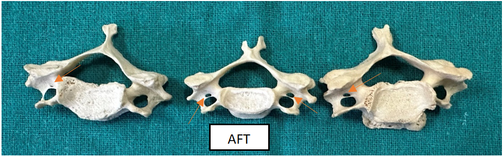 Figure 6: The accessory foramen transversarium in typical cervical vertebrae.