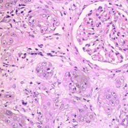 Figure 2: Collecting duct carcinoma delineating nests, cords, tubules and papillae layered by pleomorphic epithelial cells incorporated with eosinophilic cytoplasm, pleomorphic nuclei with coarse chromatin and prominent nucleoli. Surrounding stroma is desmoplastic and inflamed [6].