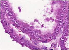 Figure 1: Fumarate hydratase deficient renal cell carcinoma demonstrating papillary structures layered with high grade, malignant epithelial cells incorporated with abundant cytoplasm and vesicular nuclei with nucleolar inclusions and peri- nucleolar clearing.