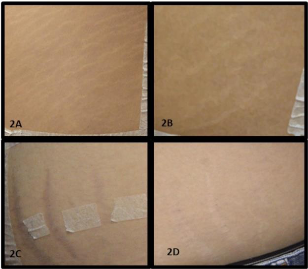 Figure 2: Example of two patients treated. Figures 2A e 2B represent a patient with moderate striae and figures 2C and 2D show a patient with severe striae before (2A and 2C) and after treatment (2B and 2D).