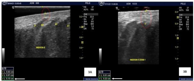 Figure 3: Ultrasound images before and after 6 months of PLLA application. Circles and arrows show the dermal thickness.