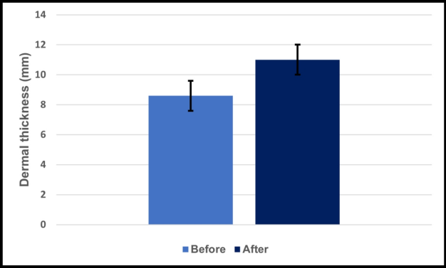 Figure 4: Mean dermal thickness around the striae before and after 6 months of the application, analyzed by ultrasound.
