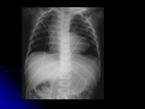 Figure 1: Chest XR showing Boot shaped shape of the heart, bilateral diminished pulmonary vuscualture and right sided aortic arch seen in 30% of all TOF. Electrocardiogram (figure 2) shows right axis deviation with right ventricular hypertrophy, rarely right atrial hypertrophy is seen.