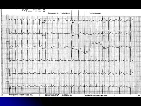 Figure 2: Electrocardiogram showing Right axis deviatio and Right ventricular hypertrophy with positive T in V1-2.