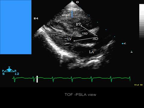 Figure 3: 2D echocardiogram in parasternal Long axis view showing Overriding of the aorta.