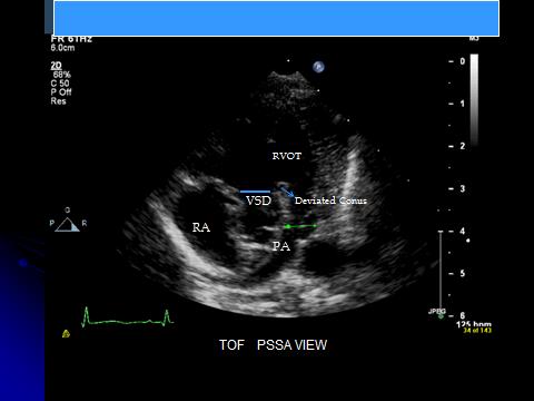 Figure 4: 2D echocardiogram showing anterior deviation of the Conal septum causing VSD and sub-pulmonic stenosis.