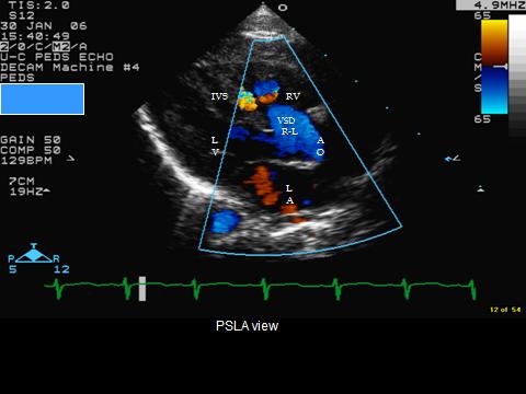 Figure 6: Color doppler showing right to left shunt through the VSD.