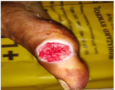 Figure 1: The Tumor on Right Foot Showing Ulceration.